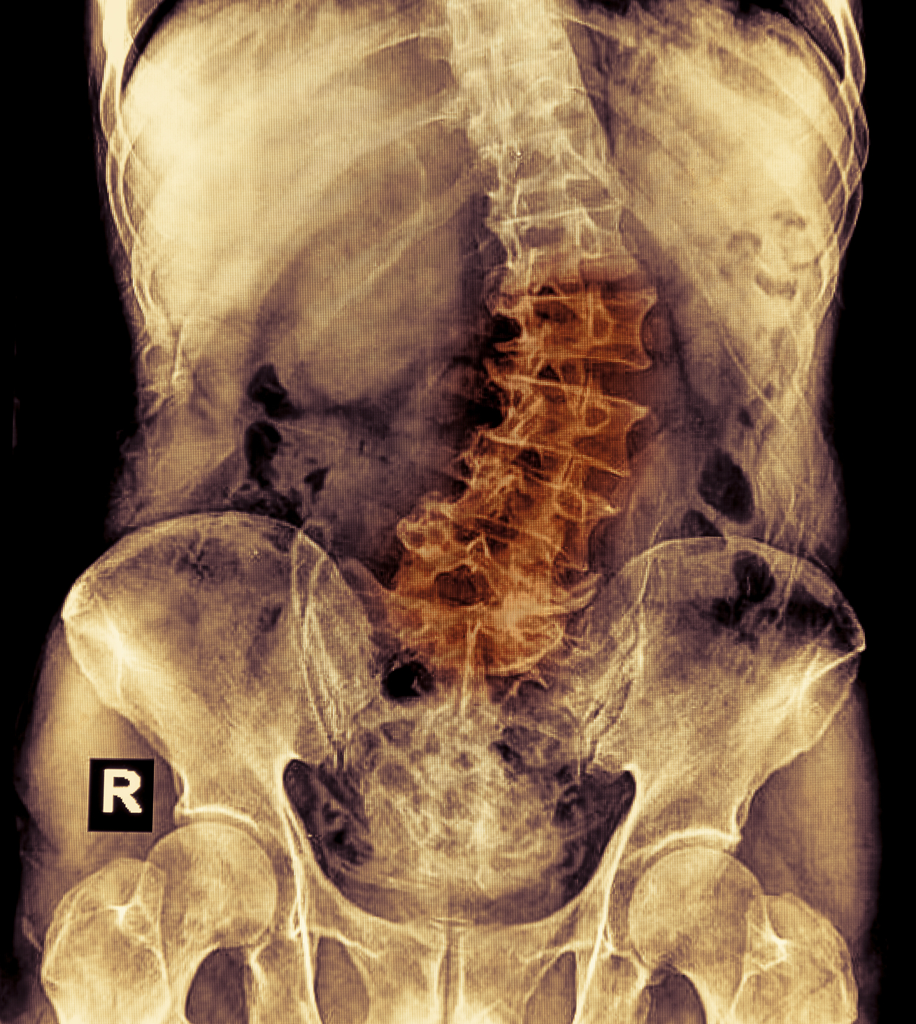 Herniated Lumbar Disc Treatment