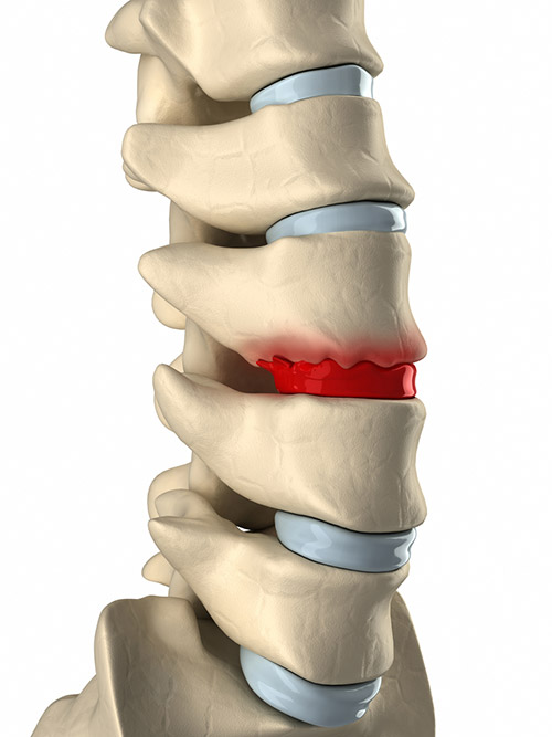 Understanding Spinal Bone Spurs and the Benefits of Back Surgery
