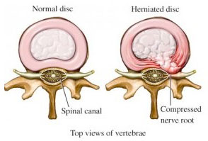 Disc Herniation Milwaukee