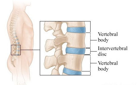 Herniated Disc Treatment