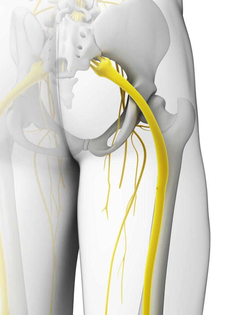 Sciatica, Lower Back Pain & the Sciatic Nerve