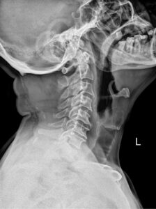 Cervical Disc