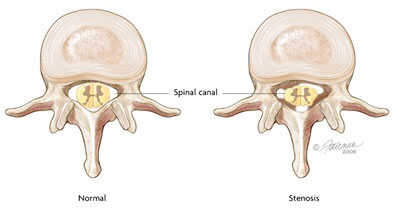 Stenosis