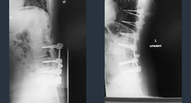Surgical Spine Case - Restored Lumbar Curve