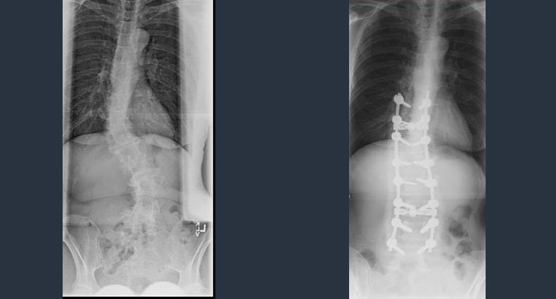 Surgical Spine Case - Scoliosis